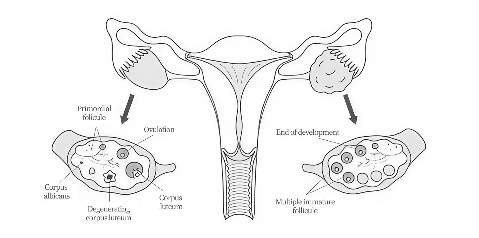 Diagram of female reproductive system and PCOS 
with labeled parts on a white background